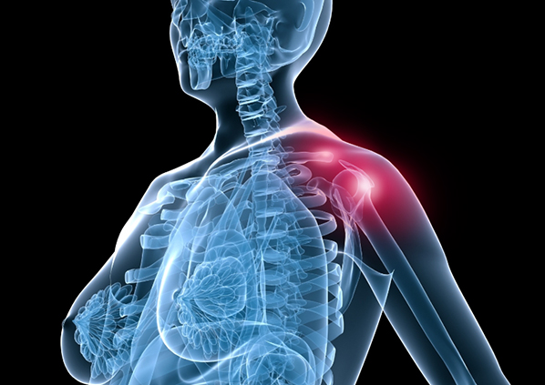 은평더바른신경외과 회전근개파열